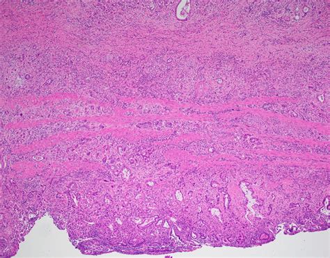 Pathology Outlines Gallbladder Carcinoma