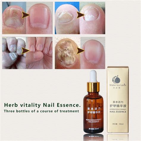 Chinese Medicine Fungal Nail Treatment Essence Nail And Foot Whitening