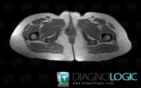 Cas Radiologie Kyste Des Glandes De Bartholin Irm Diagnologic