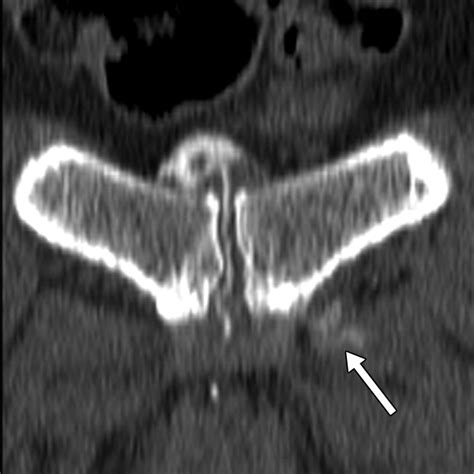 The Role Of Pubic Symphyseal CT Arthrography In The Imaging Of Athletic