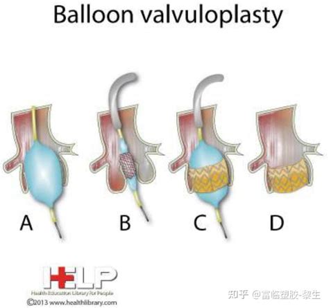 微创手术球囊的现代应用（总结）poba Plain Old Balloon Angioplasty 知乎