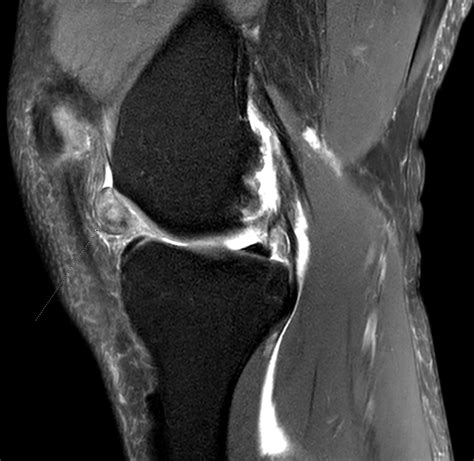 Benoît Rizk On Twitter Infrapatellar Ovoid Mass Would You Call This Localized Nodular