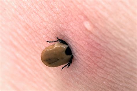 Tick Bite Pictures And Symptoms What Does A Tick Bite Look Like