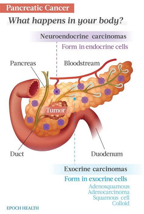 The Essential Guide to Pancreatic Cancer: Symptoms, Causes, Treatments