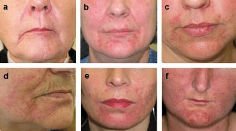 Clinical Examples Of Posdi Scoring Of Perioral Dermatitis Download