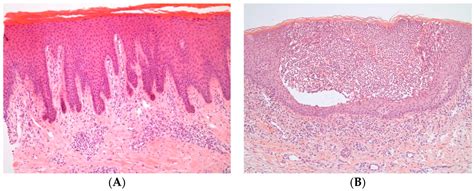 IJMS Free Full Text Psoriasis Pathogenesis And Treatment