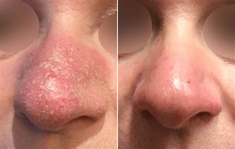 Rosacea Before And After Beauty And The Brows Hot Sex Picture