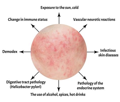 Rosacea