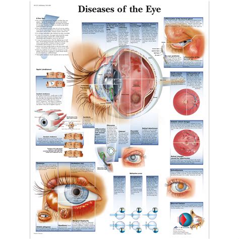 Doenças Nos Olhos Causadas Por Bacterias - Pôster das Doenças do Olho | 4006666 | VR1231UU | Olhos | 3B Scientific