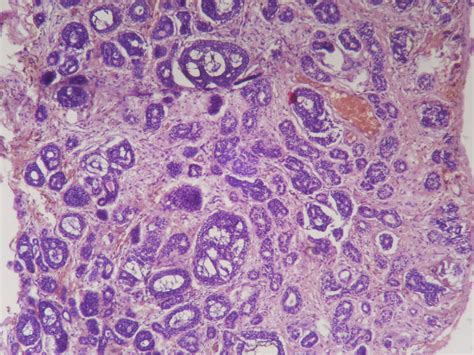 Adenoid Cystic Carcinoma Histopathologyguru