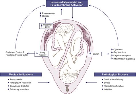 Preterm And Term Labour In Multiple Pregnancies Seminars In Fetal And Neonatal Medicine