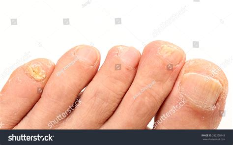 Toenail Fungus Peak Infection Stock Photo Shutterstock