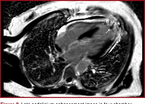 Figure From A Case Of Acute Myocardial Infarction Mimicking Tako