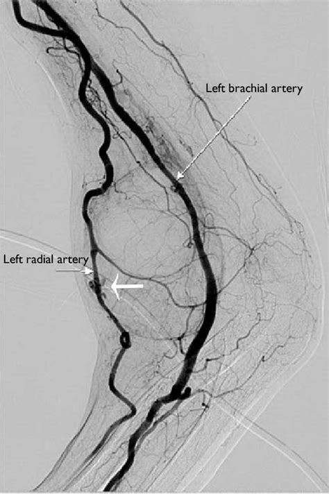 Digital Subtraction Angiography Of The Left Upper Limb Shows A High