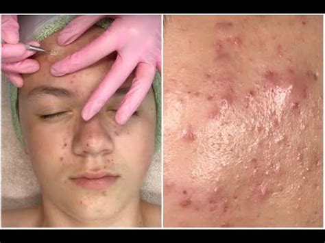 Acne Clarifying Facial Hd Pimple Popping Super Informative