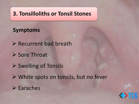 PPT - 8 Causes of White Spots On Tonsils You May Not Know PowerPoint ...