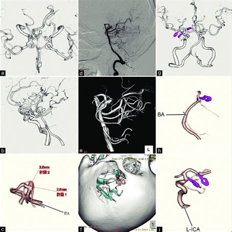 A Preoperative Three Dimensional Computed Tomography Angiography Of