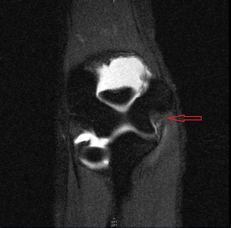 Ulnar Collateral Ligament Mri