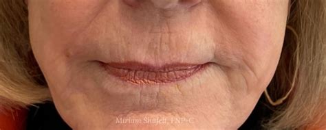 Fillers Case 6870 Faces PLLC In Ridgeland MS