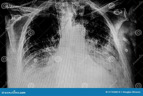 Chest X Ray Showing A Patient With Tracheostomy Tube Stock Sexiz Pix