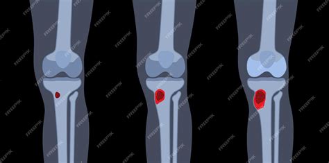 Enfermedad De Osteomielitis Dolor De Huesos Muertos De Rodilla