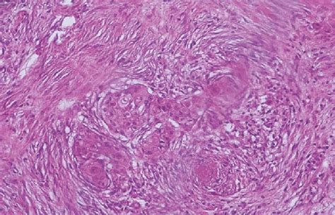 Hematoxylin And Eosin Staining Invasive Carcinoma With Squamous Cell Download Scientific