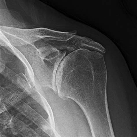 Acromioclavicular Joint The Other Joint In The Shoulder Ajr