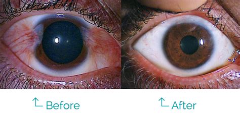 Pterygium Treatment & Recovery | Pterygium Eye Surgery