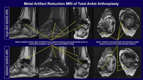 Semac Mri Of Total Ankle Arthroplasty Download Scientific Diagram