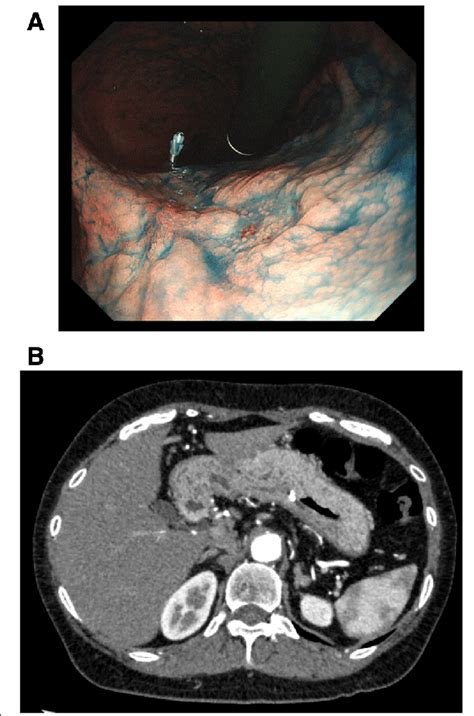 Gastric Endoscopy And Ct A Gastric Endoscopy Revealed A Type 0 Iic Download Scientific Diagram