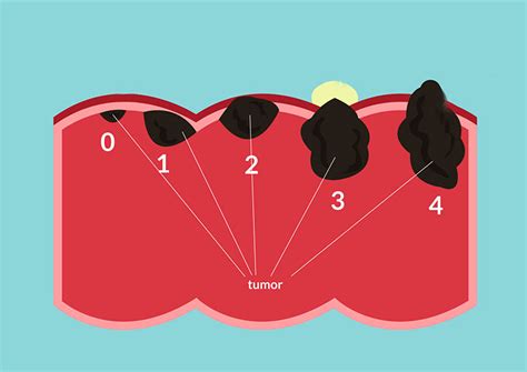 Các Giai Đoạn Của Ung Thư Đại Tràng - Thông Tin Nên Biết 