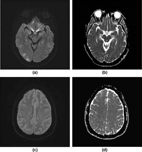 Reversible Cerebral Vasoconstriction Syndrome An Important And Common Cause Of Thunderclap And