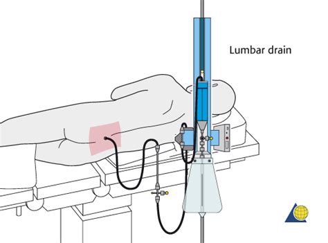 External Ventricular Drainage System Lithosmed