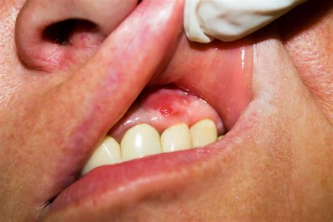 3 Signs Of An Abscessed Tooth General Dentistry Houston