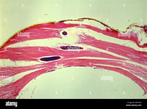 A Photomicrograph Revealing The Histology Of Onchocerca Volvulus