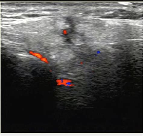 Parotid Gland Ultrasound Measurement