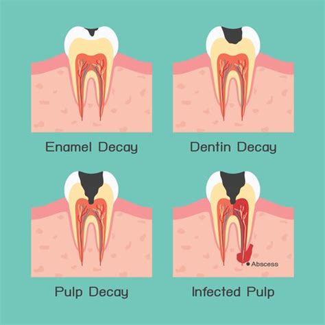 Abscessed Tooth Types Symptoms Causes Treatment Private Dentists