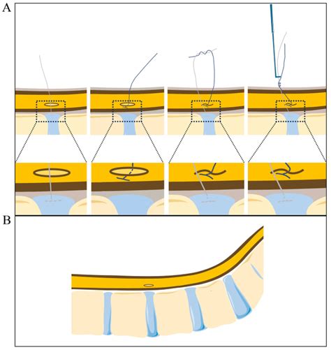 Endoscopic Double Line Suture Repair Technique For Repairing Iatrogenic