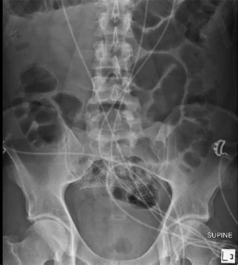 Post Procedure X Ray Colonic Stent Sigmoid Colon Download