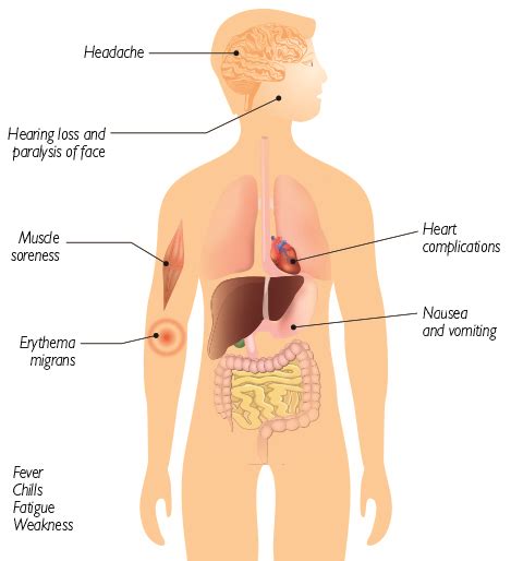 Healthy Viewpoints Lyme Diseasediagnostic And Treatment Facts And Fiction In 2017