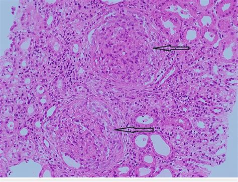 Uniform Cellular Crescents With Periglomerular Inflammation H E X200