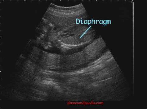 Diaphragmatic Hernia Ultrasoundpaedia