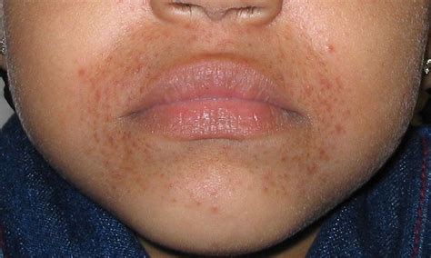 Mild Eczema Around Mouth