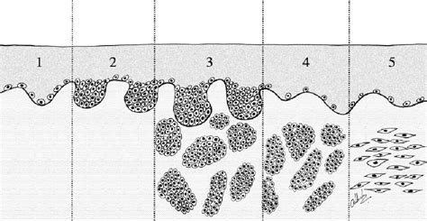 Junctional Melanocytic Nevus