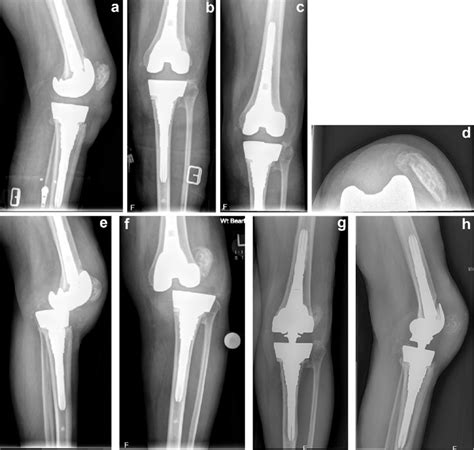 Case Preoperative Radiographs From Top Left Clockwise A D