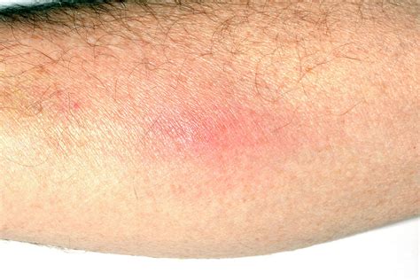 Superficial Thrombophlebitis Photograph By Dr P Marazzi Science Photo Library