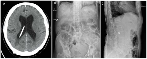 Neuronavigation And Laparoscopy Guided Ventriculoperitoneal Shunt