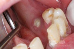 Osteonecrosis De Los Maxilares Por Bifosfonatos Cl Nica Dental Borr S