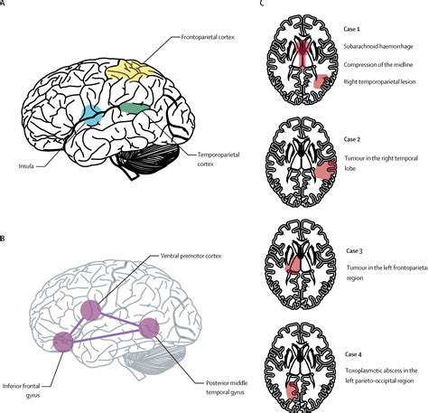 The Felt Presence Experience From Cognition To The Clinic The Lancet