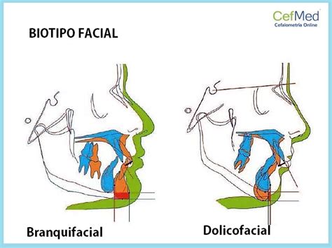 Biotipo Facical Y Sus Distinas Variables De Biotipo CefMed